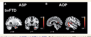 Towards a neurocomputational account of social dysfunction in neurodegenerative disease