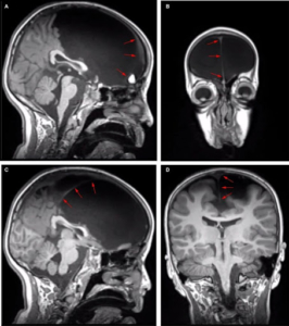 Early bilateral and massive compromise of the frontal lobes